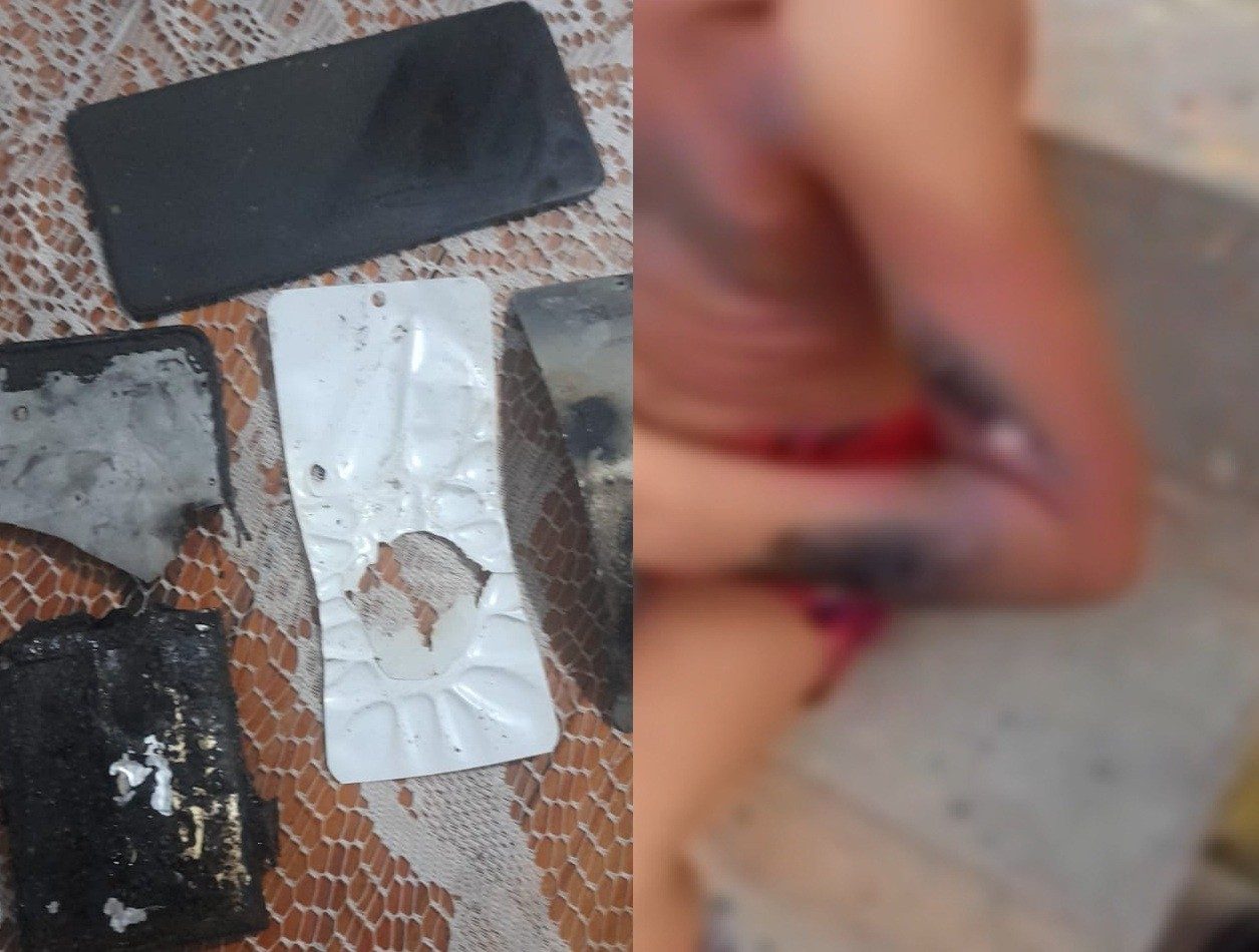 Menino de 6 anos tem corpo queimado após celular explodir enquanto jogava videogame no Recife