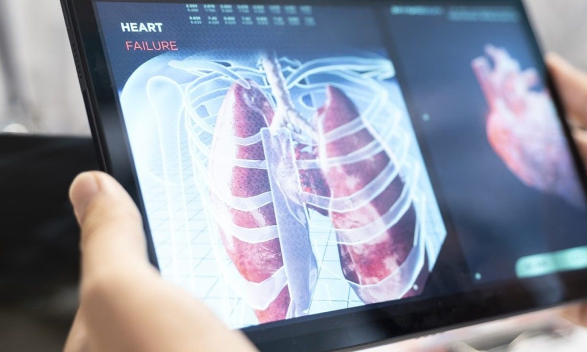 Câncer de pulmão: rastreamento por tomografia reduz sua mortalidade
